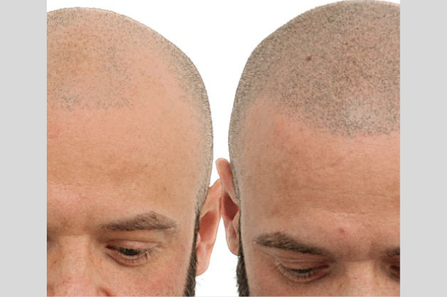 hair loss treatment in pune