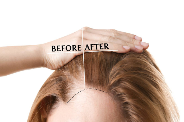 best doctor in pune for hair loss treatment