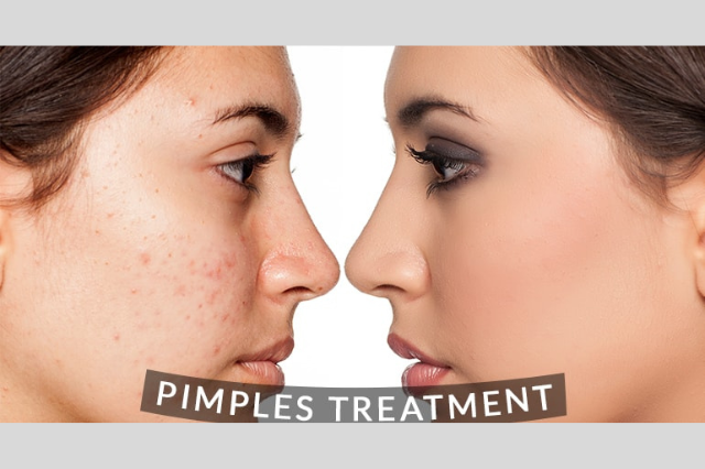 Chemical Peels Near Me